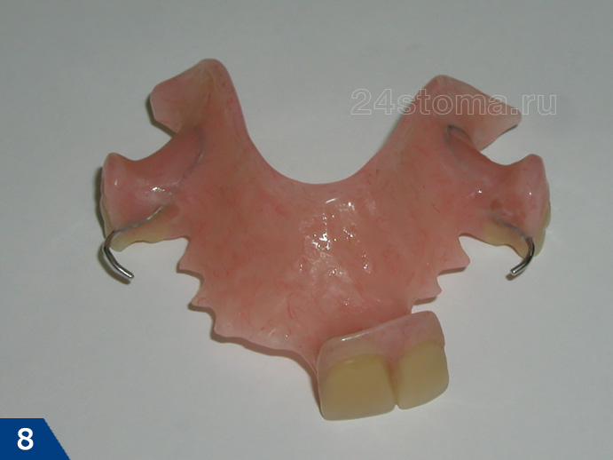 Съемный зуб бабочка. Частичный съёмный протез - иммедиат. Иммедиат протез на 1 зуб на нижней челюсти. Иммедиат протез на нижнюю челюсть. Иммедиат протез на 1 зуб на верхней челюсти.